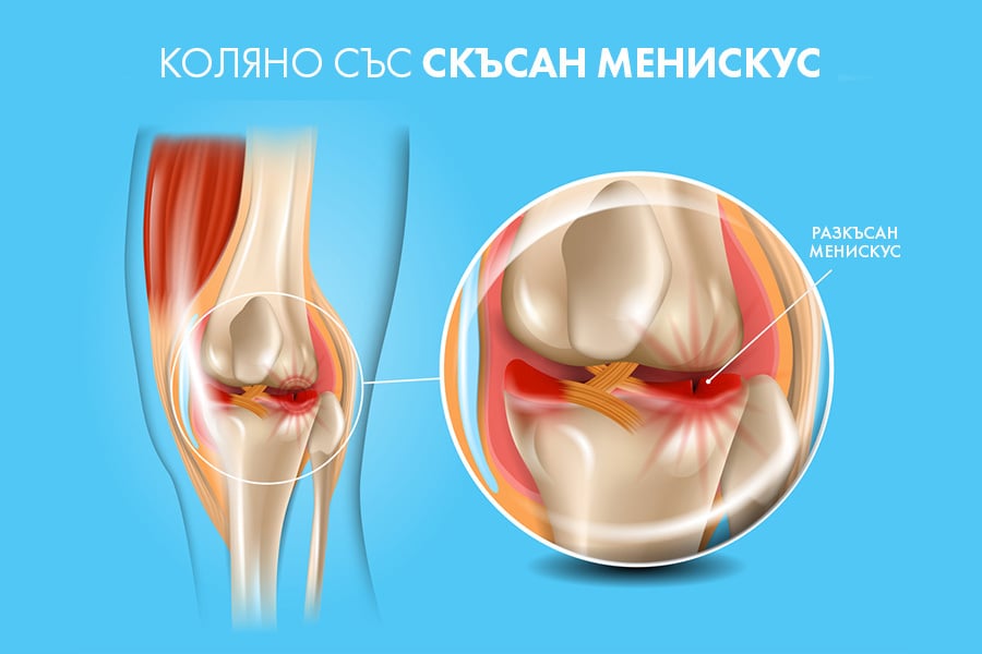 скъсан менискус