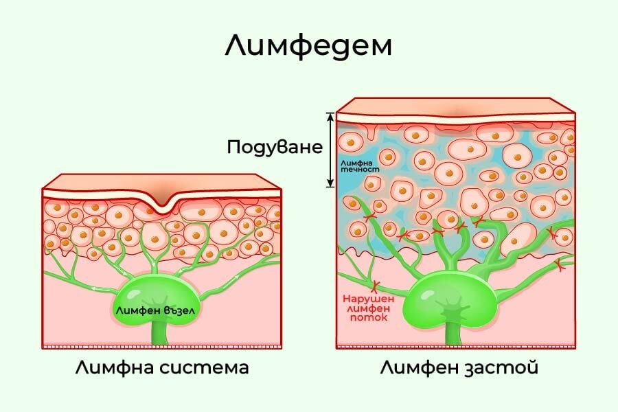 Лимфен застой и как да се справим с отоците по естествен път 5 лимфен застой, лимфедем