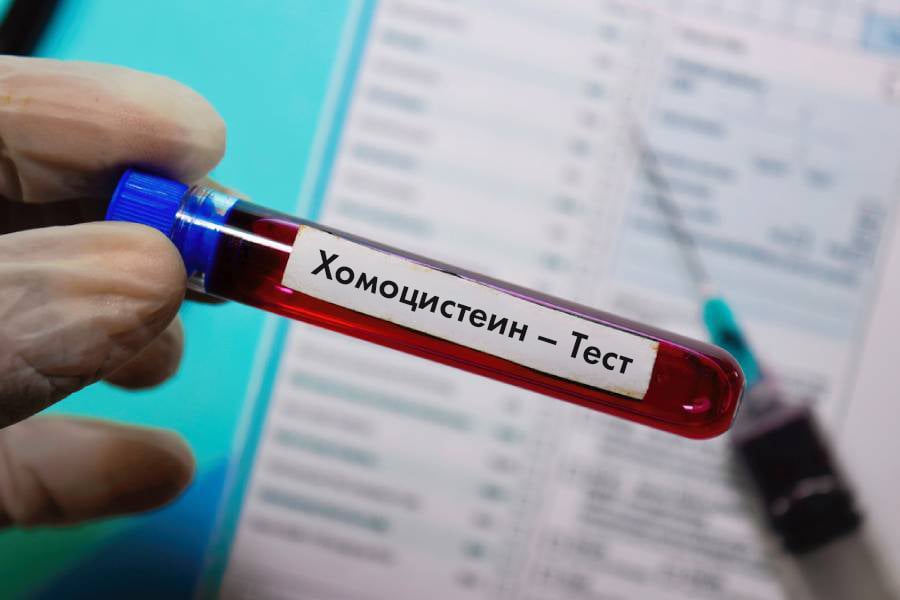 Висок хомоцистеин: Какво означава и защо не е за подценяване? 11 висок хомоцистеин